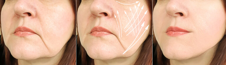 lower face lift non surgical