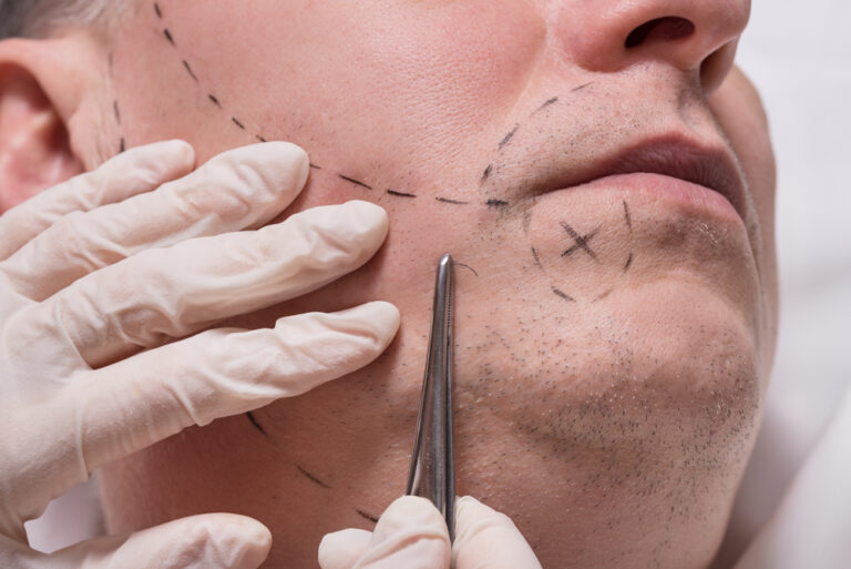 moustache hair transplant