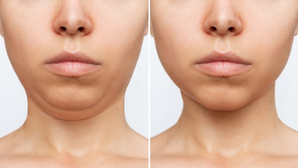 double chin liposuction/ reduction