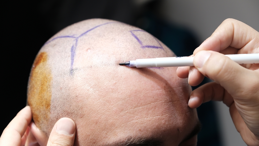 Hair transplant marking