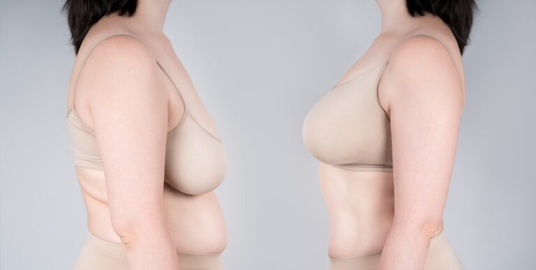 breast reduction surgery