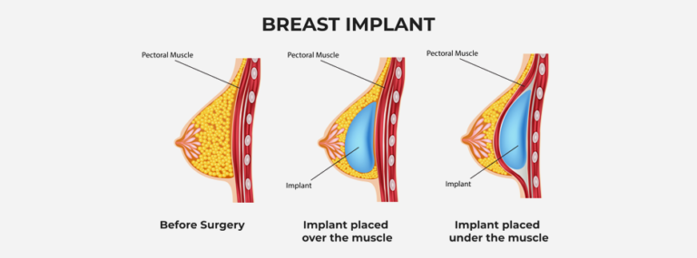 breast implant method
