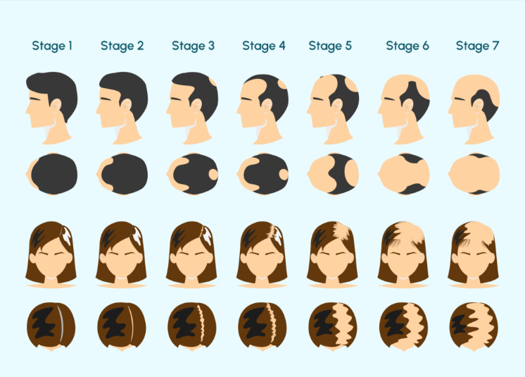 baldness stages