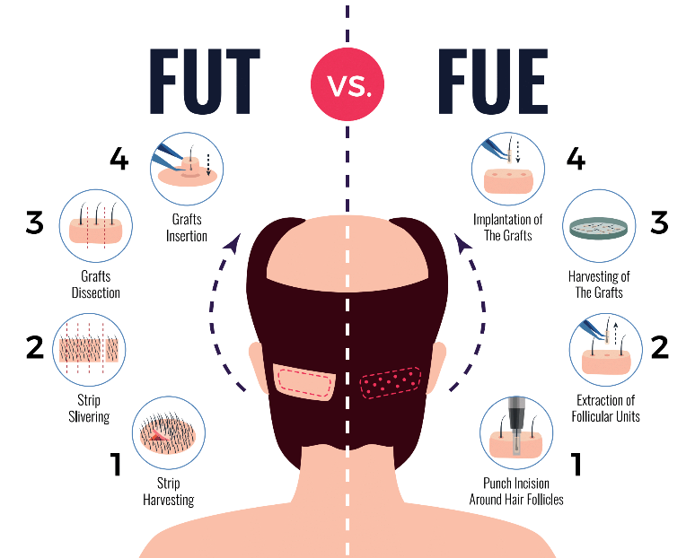 FUE vs FUT comparision