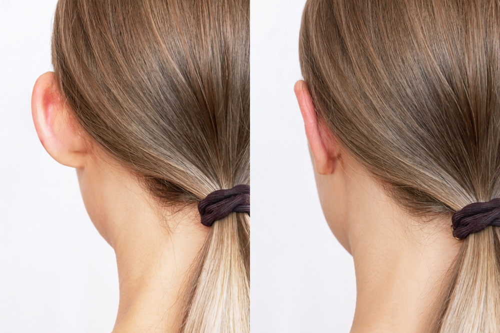 otoplasty- bat ear correction