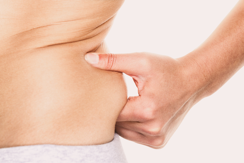 love handle liposuction