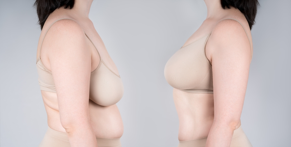 breast reduction