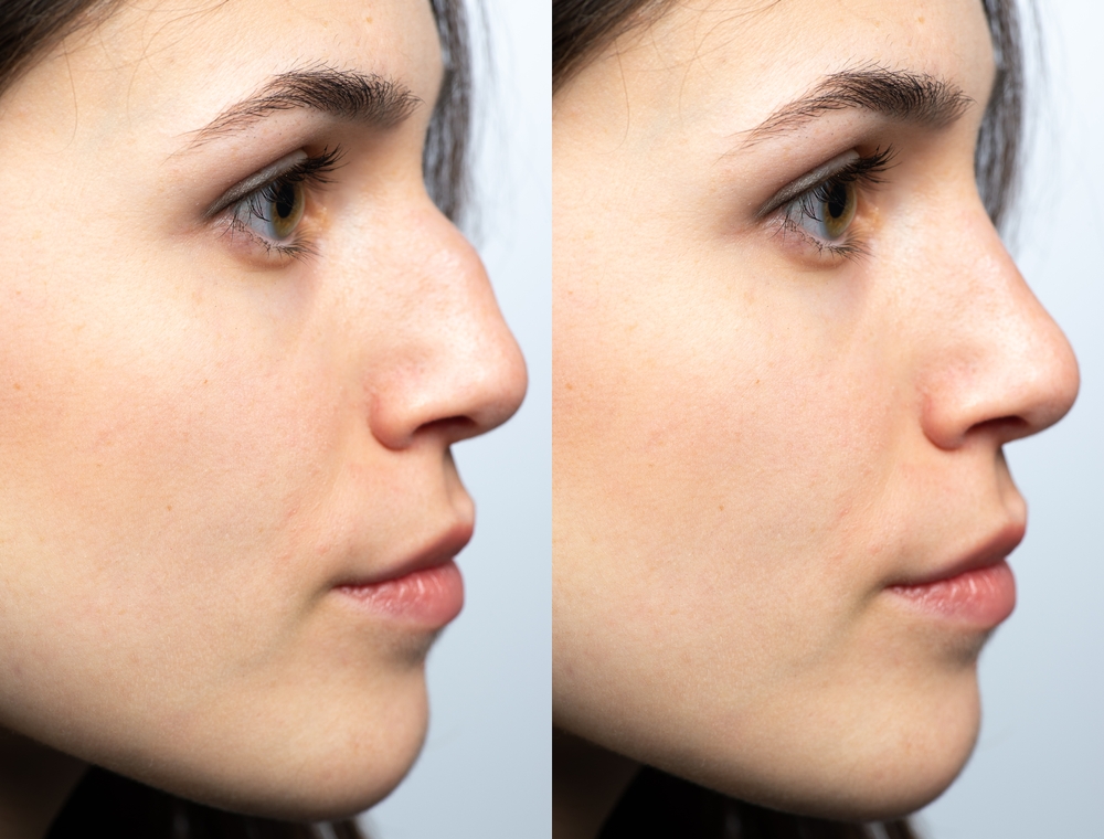 nasal hump removal