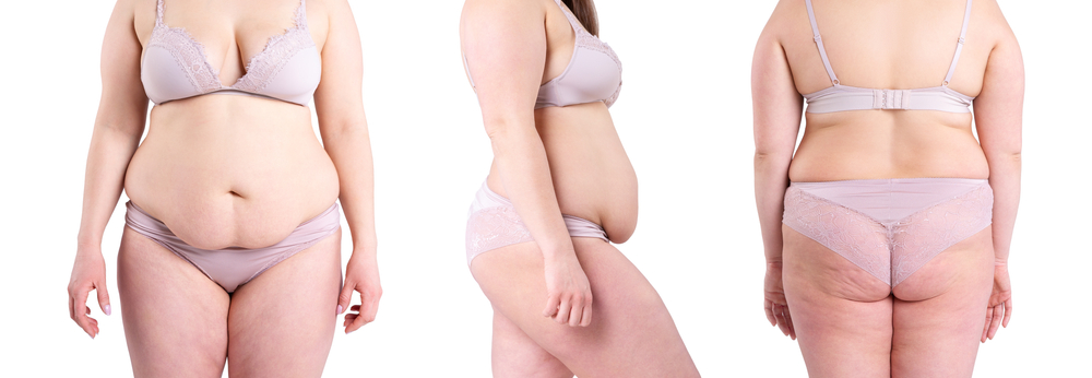 female body contouring