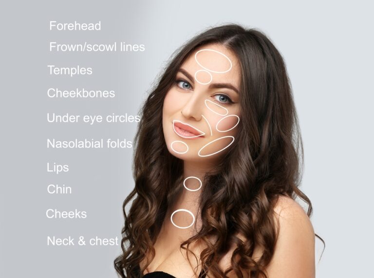 dermal filler areas