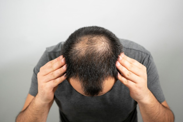 Hair-transplant