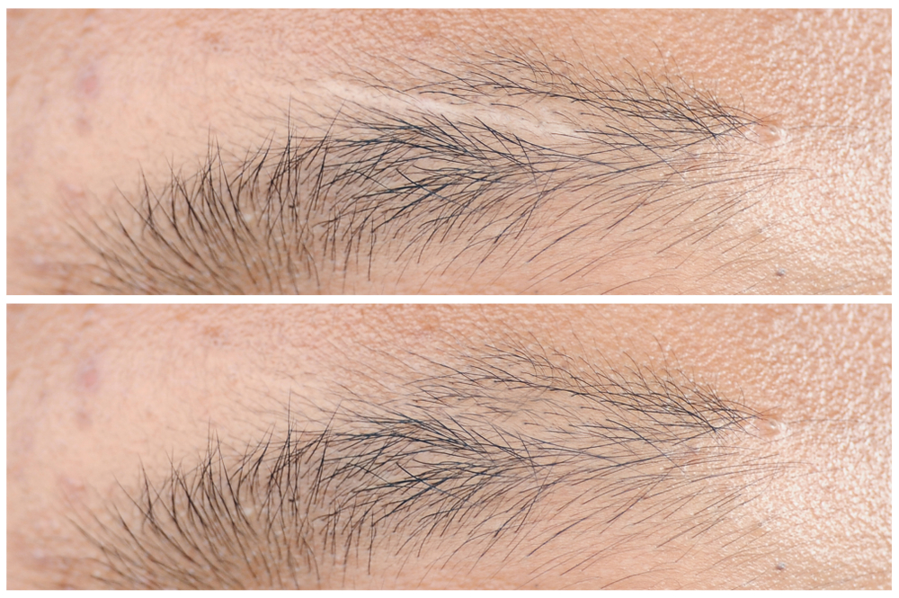 post burn scar hair transplant