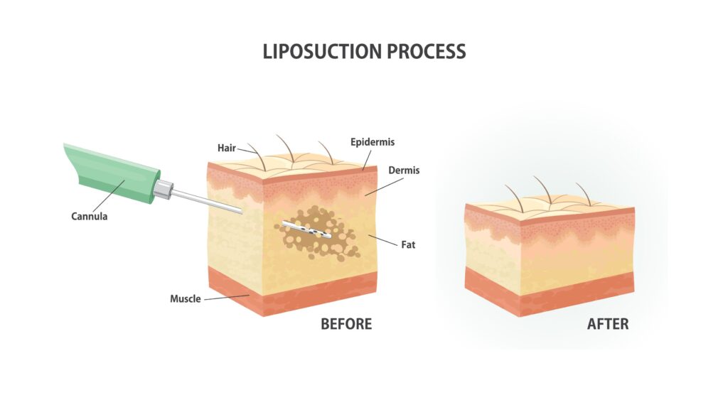 liposuction process