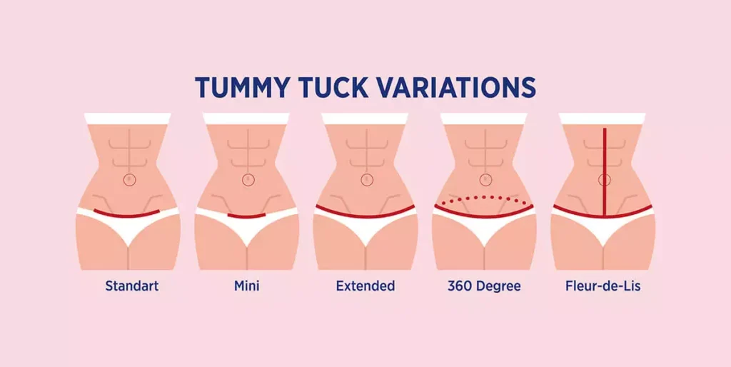 tummy tuck types