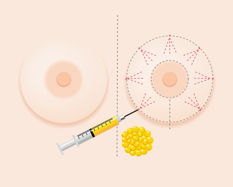 breast augmentation by fat grafting
