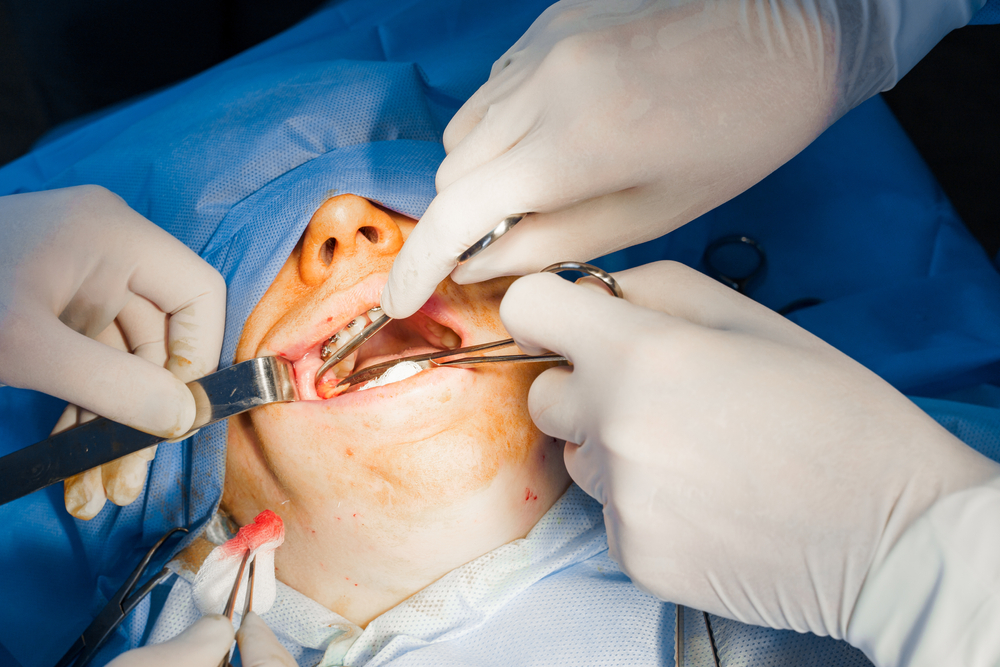 face contouring surgery