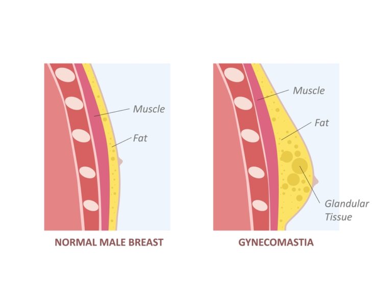 gynecomastia causes