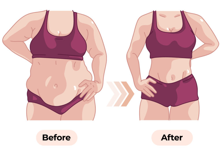 best liposuction in ahmedabad