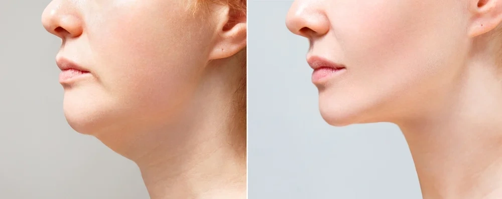Side profile of a woman showing a defined jawline and no double chin.