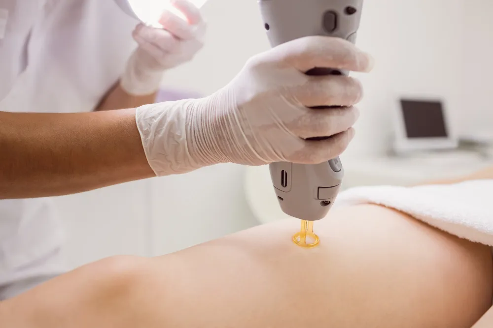 Professional IPL laser hair removal treatment process.