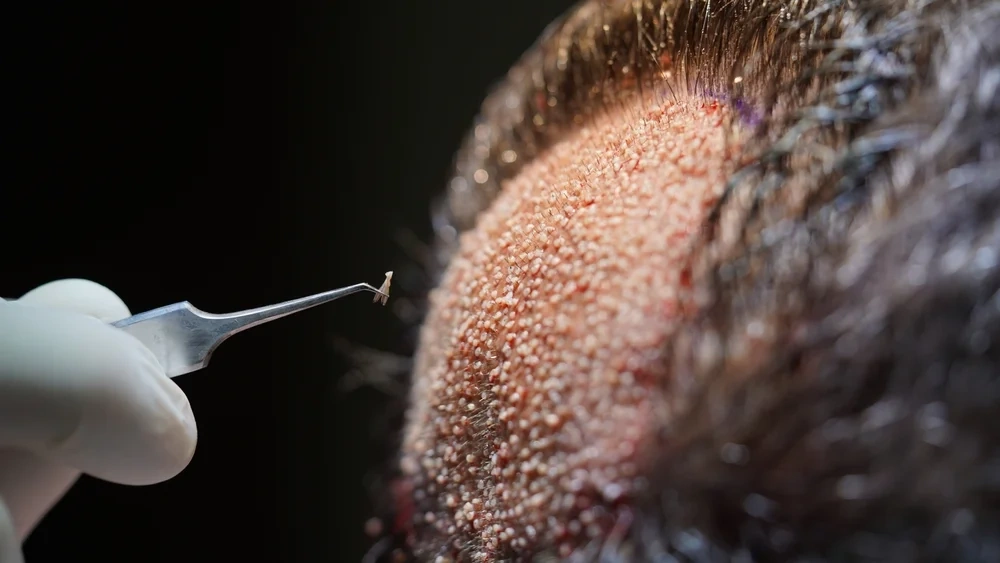 Doctor examining patient scalp for hair transplant assessment at Morph Aesthetic.