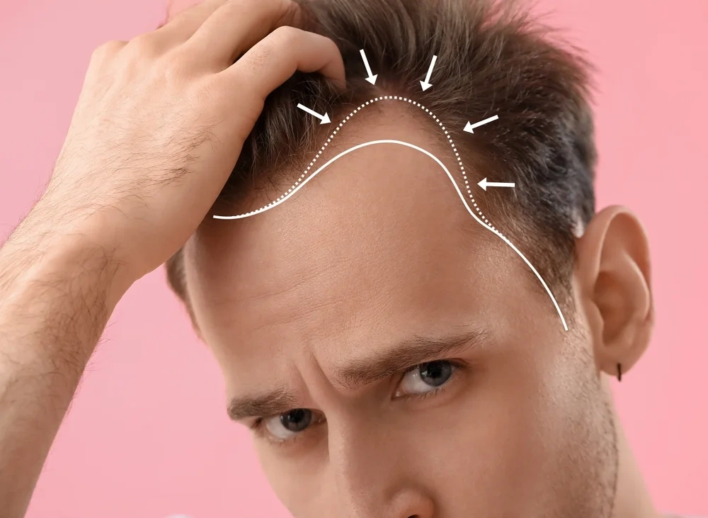 Advanced FUE procedure for Hair Transplant in Ahmedabad.
