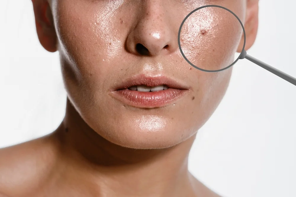 Dimple creation surgery as a popular Face Treatment in Ahmedabad.