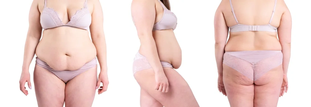 Woman showing loose skin around the waist and lower back before surgery.