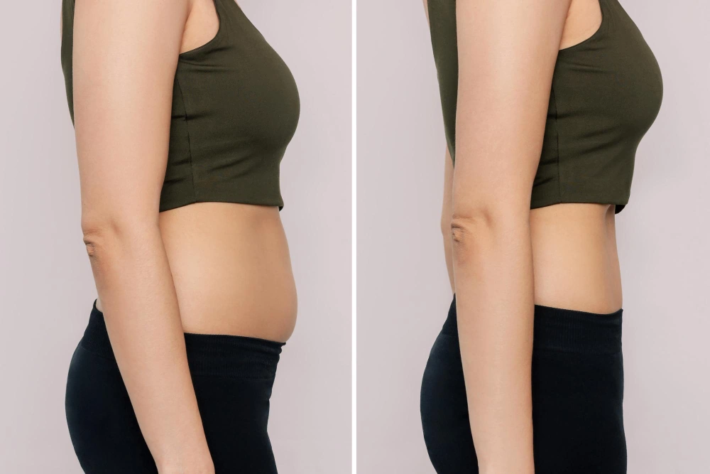 Laser liposuction results showing improved body contouring.