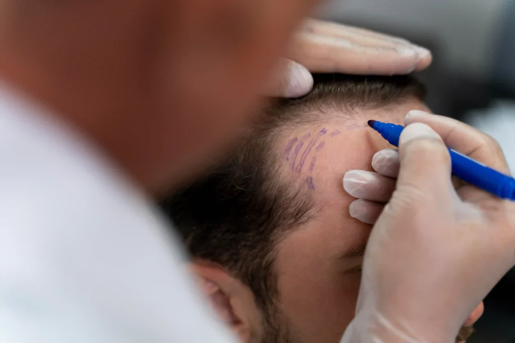 Hair Restoration Procedures at Morph