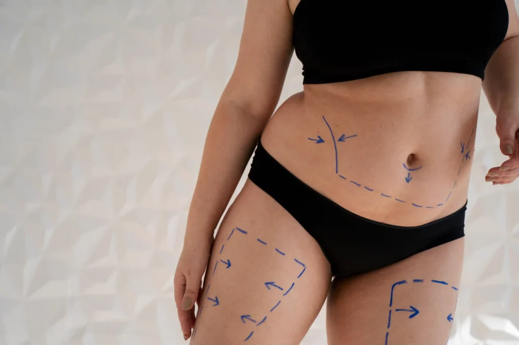 The Liposuction Process