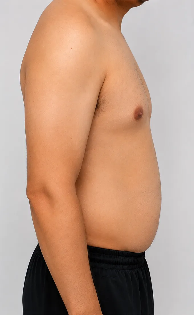 After gynecomastia surgery