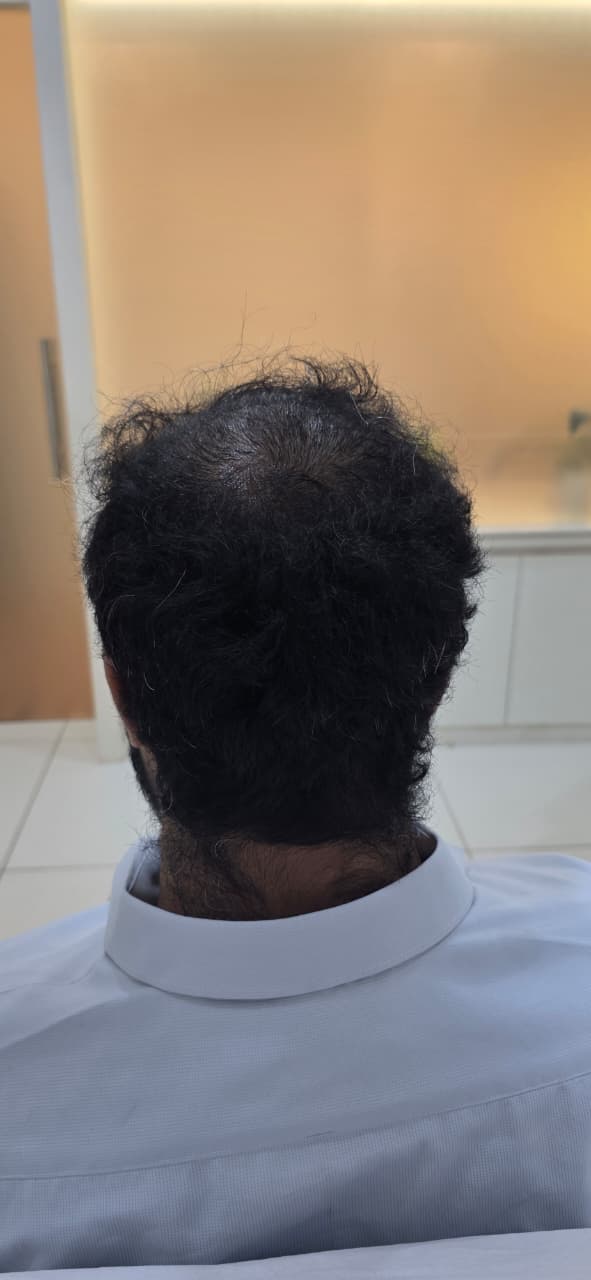 After hair transplant — full restoration