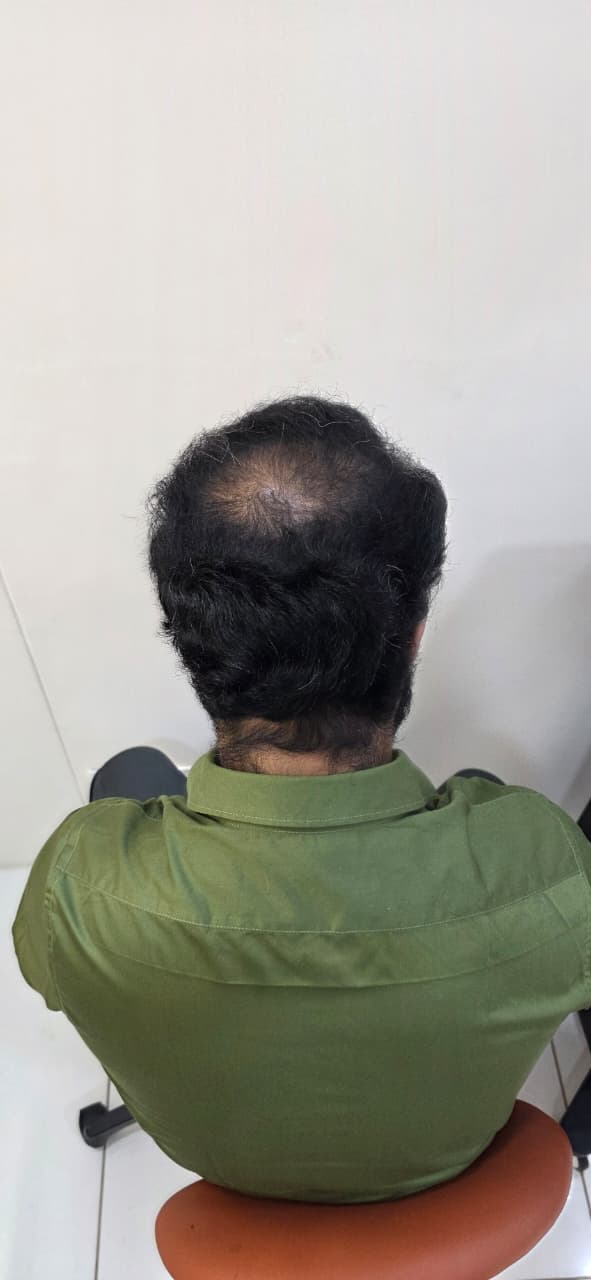 Before hair transplant — full restoration