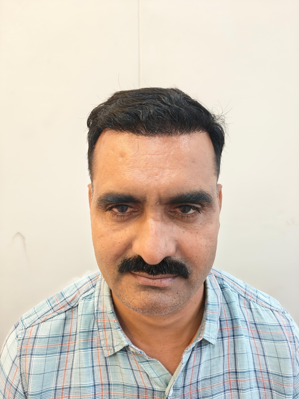 After hair transplant — full restoration