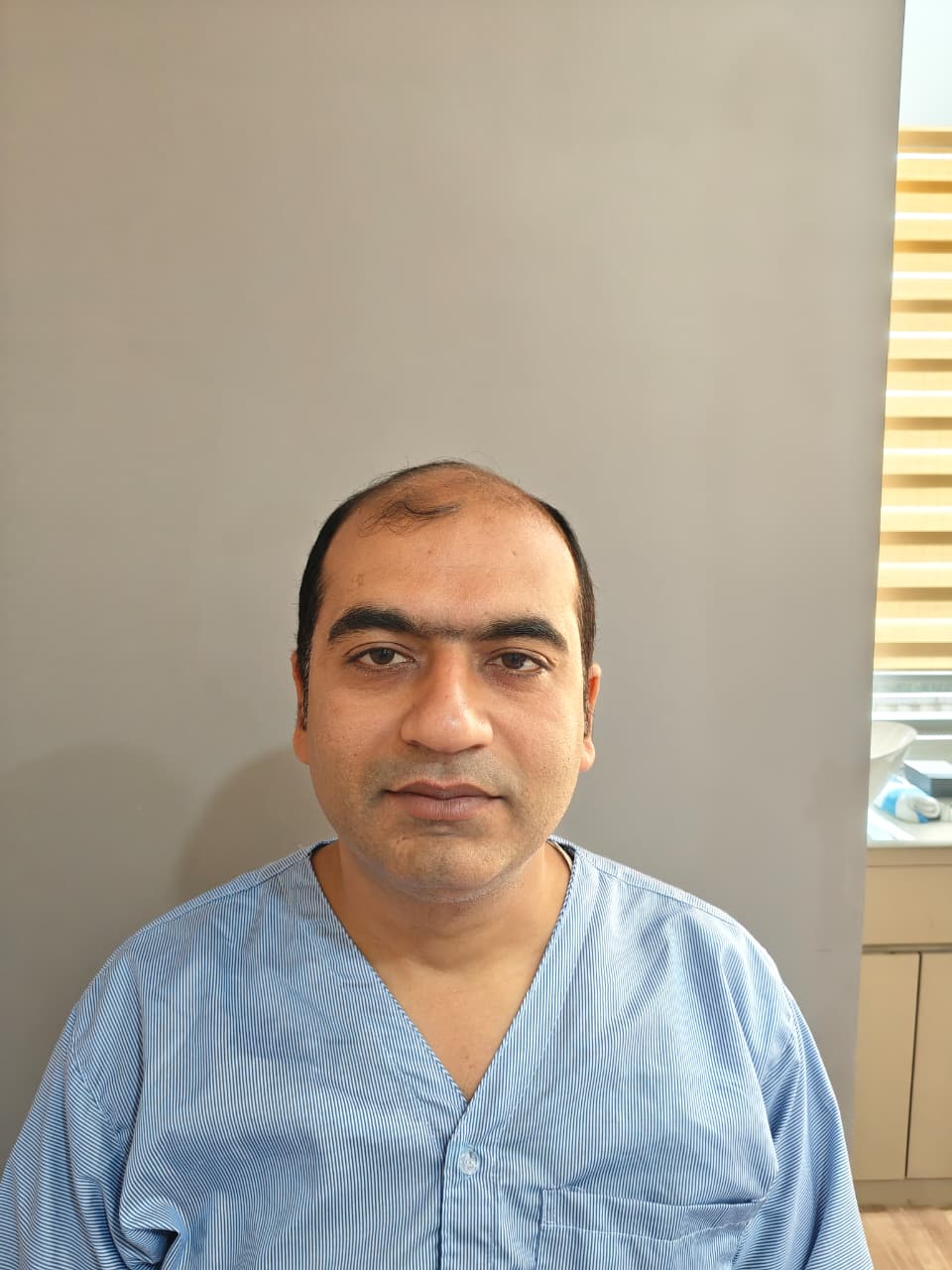 Before hair transplant — frontal hairline