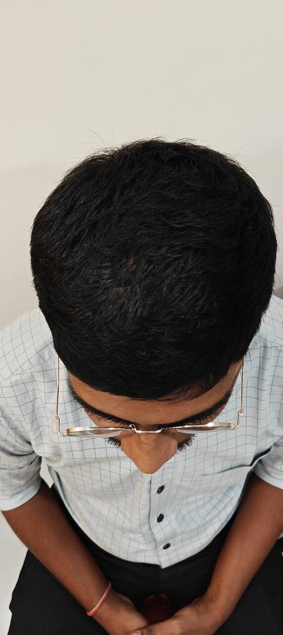After hair transplant — crown and mid-scalp