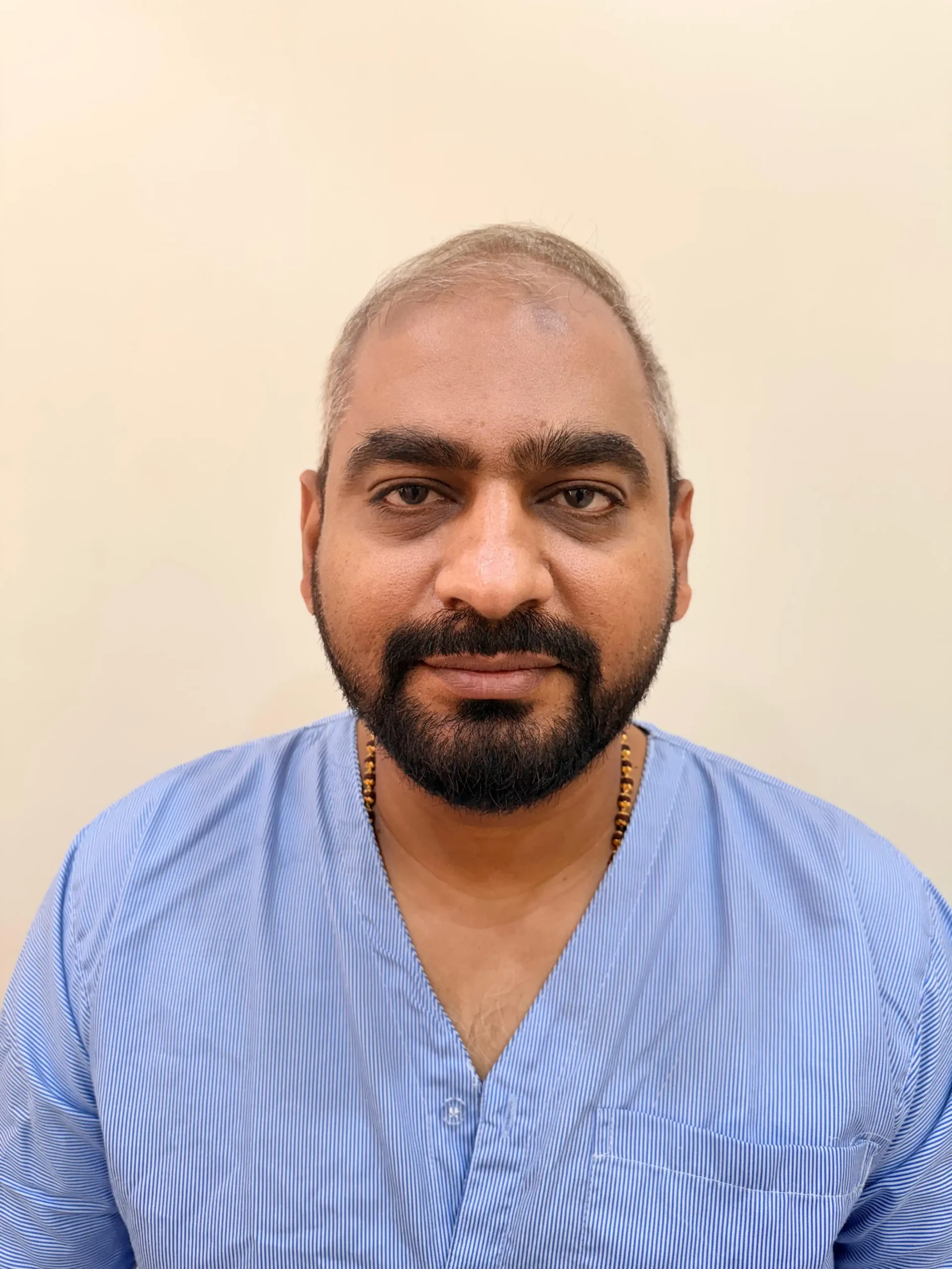 Before hair transplant — full restoration