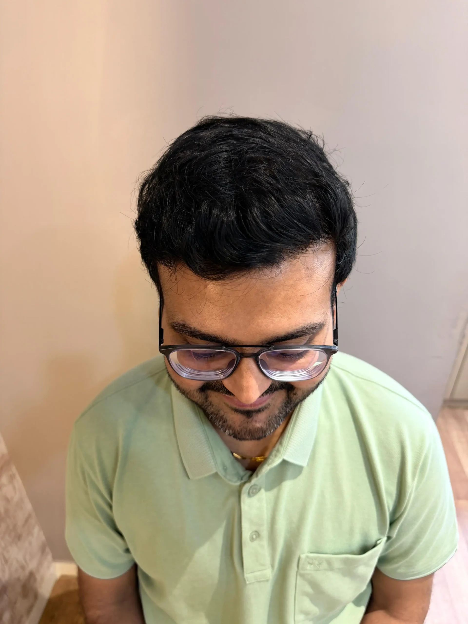 After hair transplant — full restoration