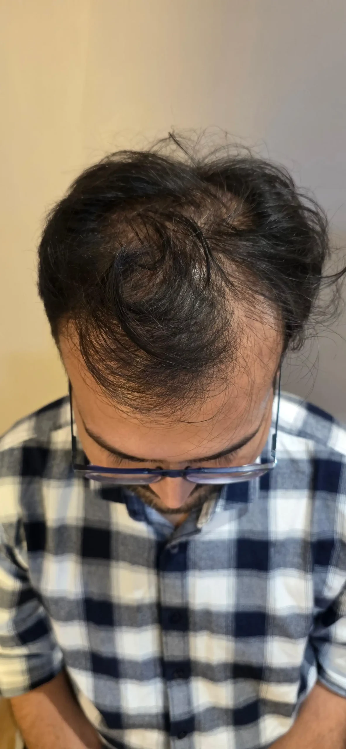 Before hair transplant — full restoration