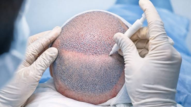 Direct Hair Transplant (DHI)