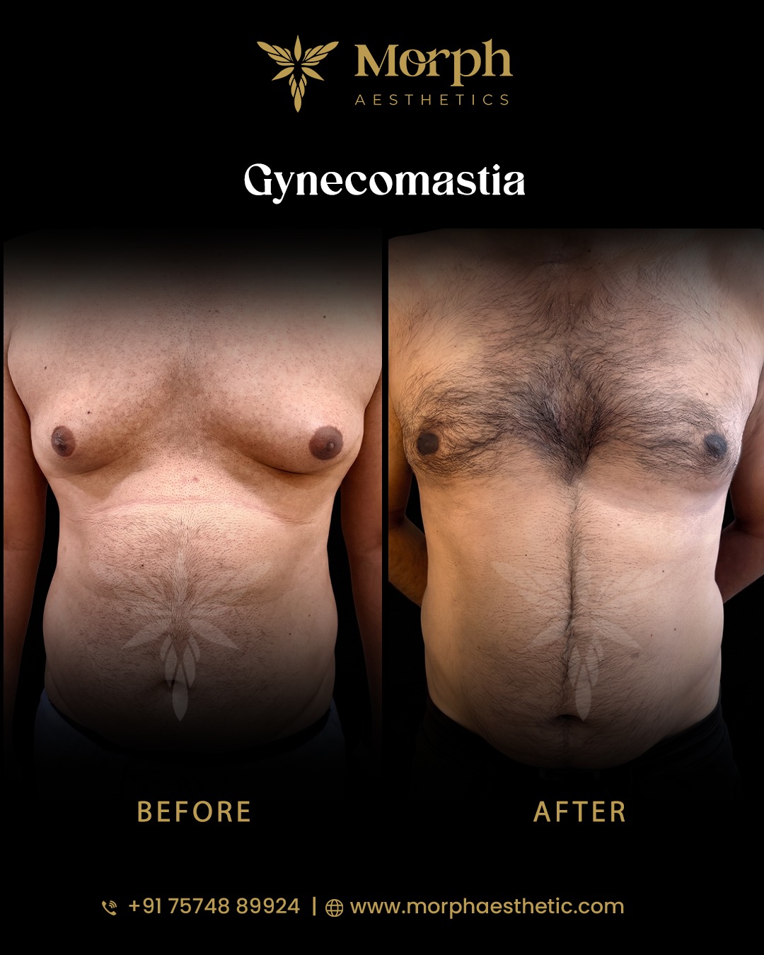 Before and after hair transplant result 2