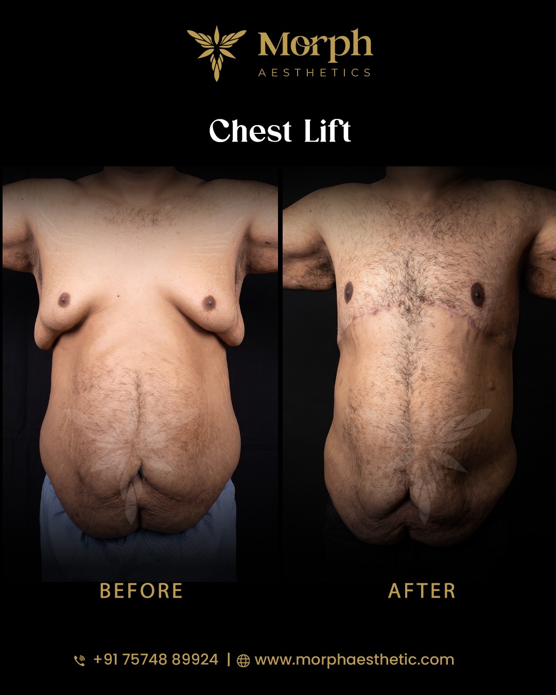 Before and after hair transplant result 5