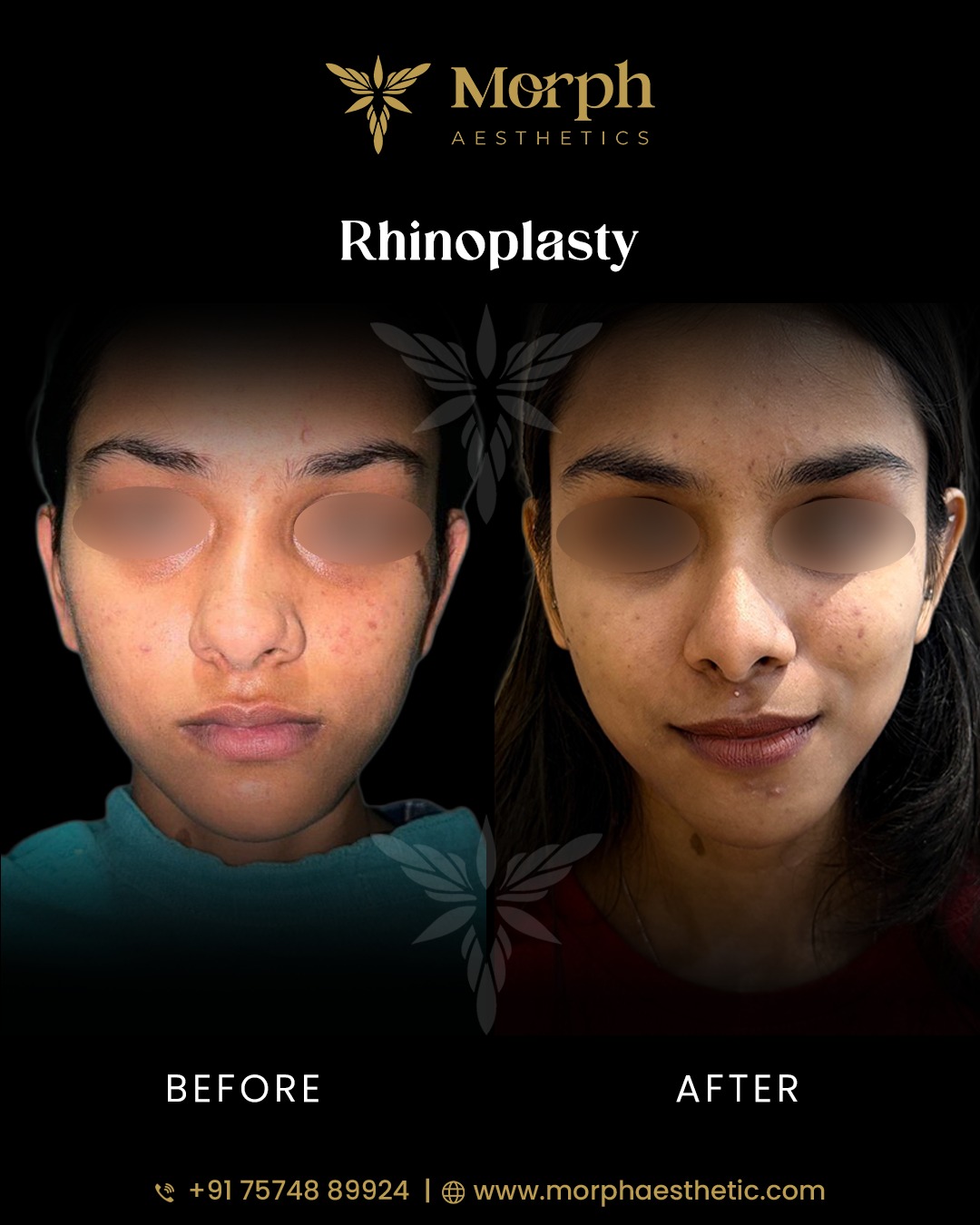 Before and after hair transplant result 5