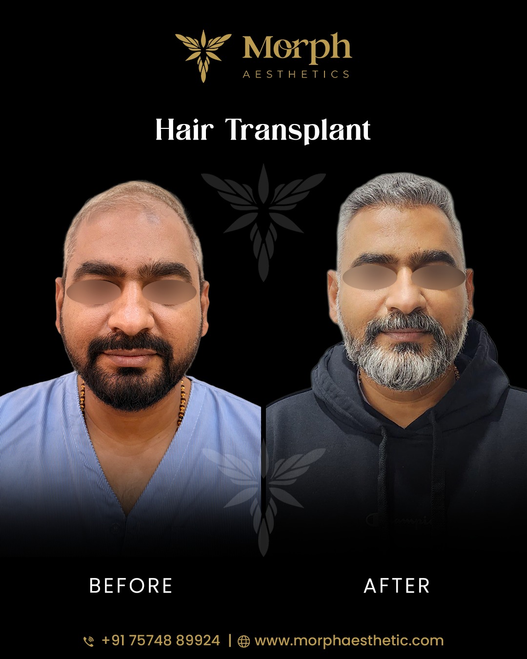 Before and after hair transplant result 1