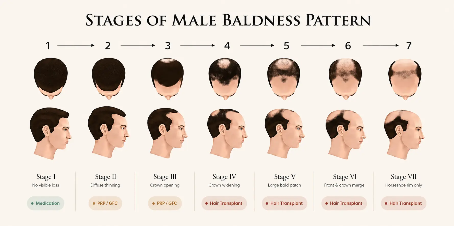 Stages of Hair Loss Norwood Scale