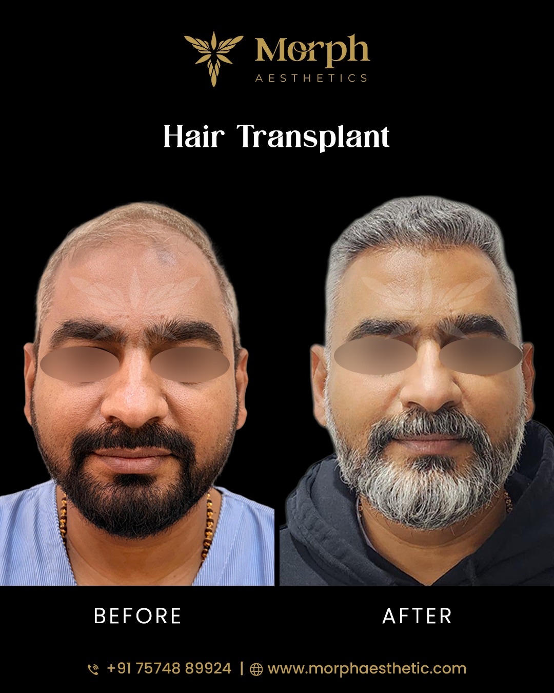 Before and after hair transplant result 1