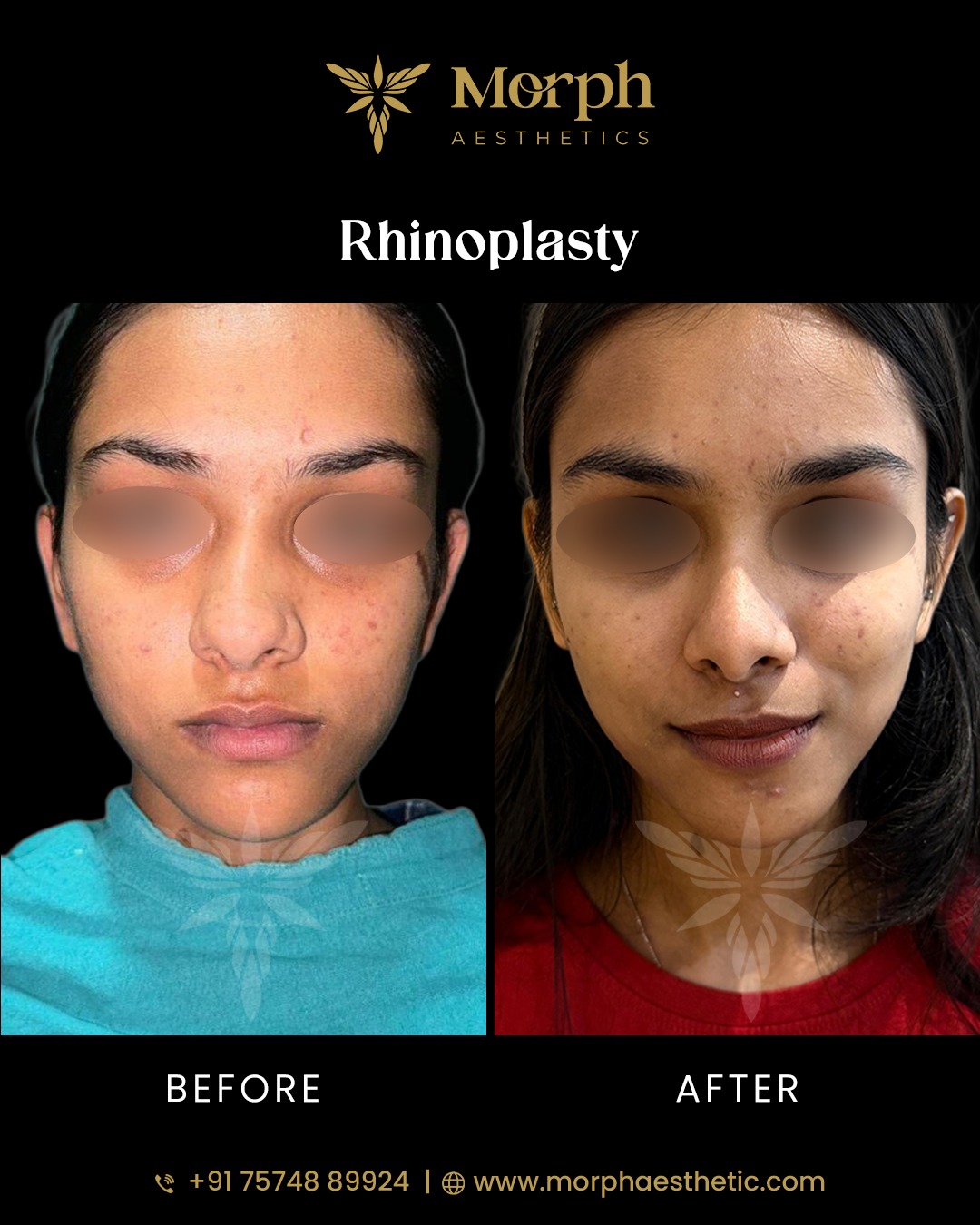 Before and after hair transplant result 5