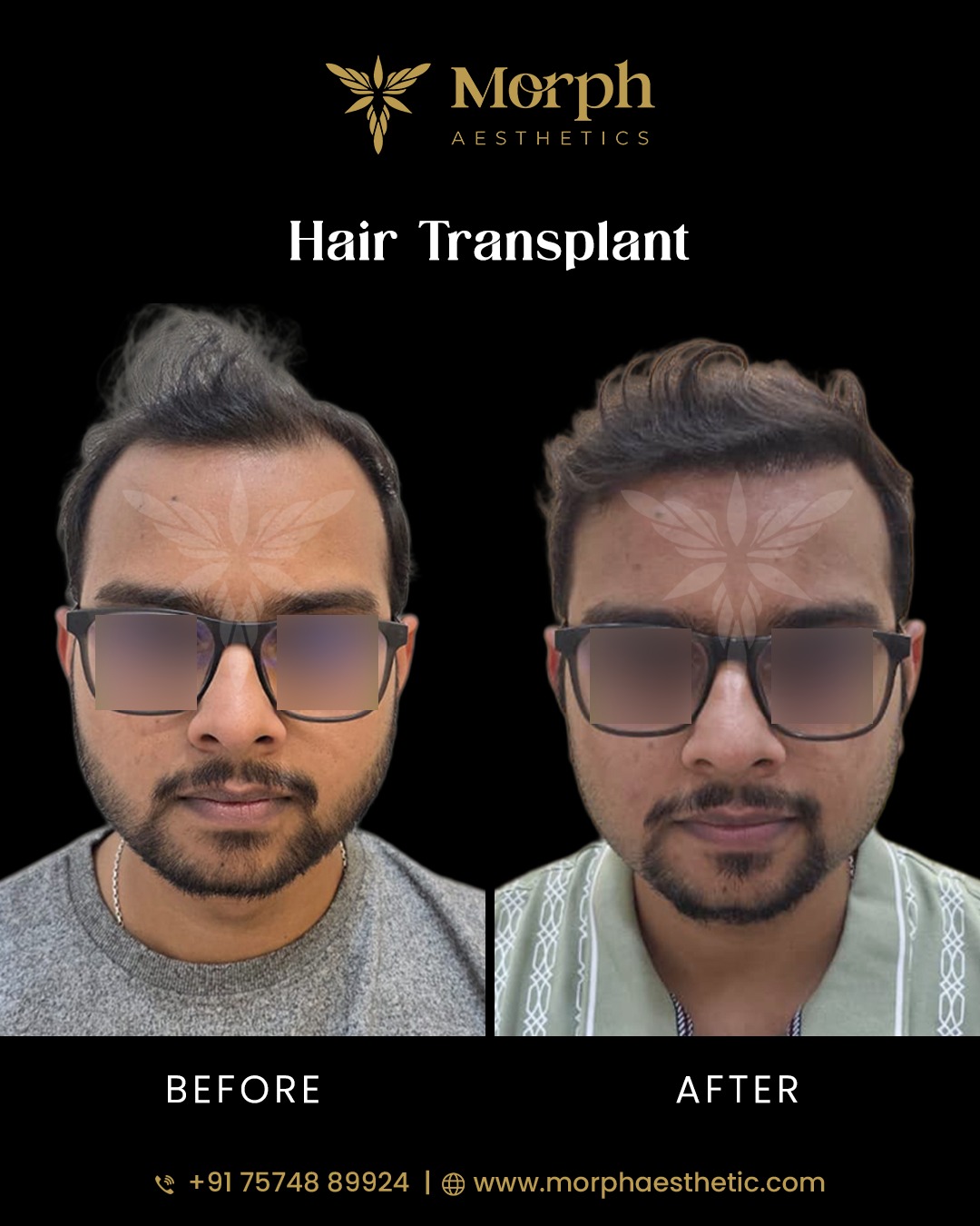 Before and after hair transplant result 1