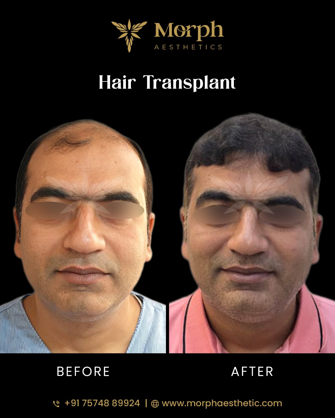 Before and after hair transplant result 2